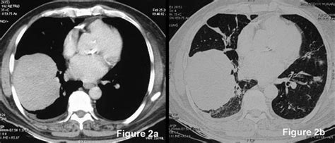 Pulmonary Lymphoma Mimicking Metastases A Case Report Cases Journal