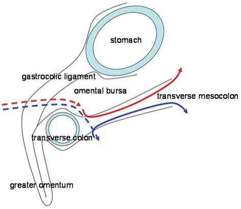 The ligament of treitz was examined in 18 autopsy cases. Clinical outcome of transperitoneal ureterocutaneostomy ...