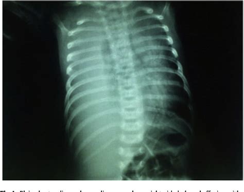 Figure 1 From Successful Treatment Of Familial Congenital Chylothorax