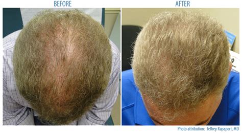 You might be able to reverse hair loss, or at least slow it. How Can PRP Help with my Hair Loss by Stimulating Hair ...