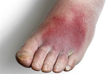 What Cellulitis Looks Like And How To Treat It