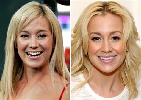 Kellie Pickler Face Cosmetic Plastic Surgery Before And After Photos