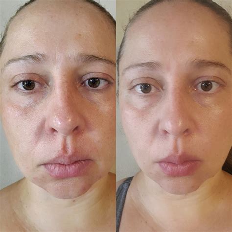 Microcurrent Facial Before And After