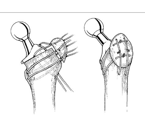 The Four Wire Technique Of Fixation Of The Trochanteric Osteotomy