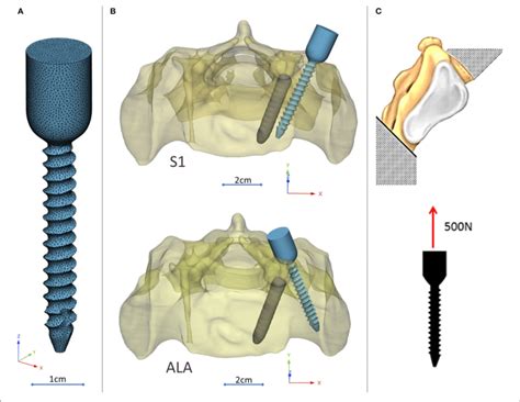 Virtual Pedicle Screw Insertion Into The Patient Specific Sacrum Download Scientific Diagram