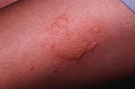 Chronic hives can cause great discomfort, often appear without warning, usually have no known cause, and can last for weeks, months, or, in some cases, even years. Chronic Hives - Causes, Symptoms, and Treatment
