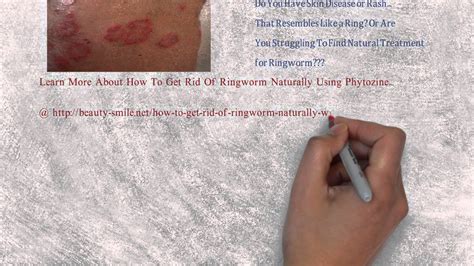 How To Get Rid Of Ringworm Naturally Using Phytozine Youtube