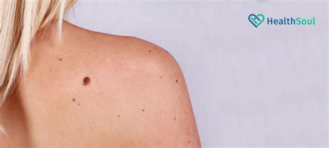 Melanoma Rare But Dangerous Skin Cancer Healthsoul