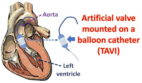 What Is Tavi All About Heart And Blood Vessels