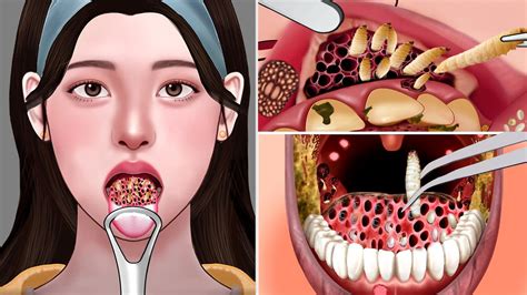 Asmr Remove Maggots Found Inside Beautiful Girls Mouth Dental Care Animation Youtube