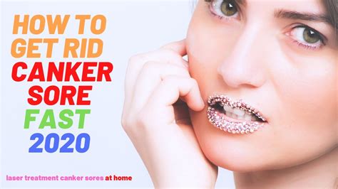 How To Get Rid Canker Sore Fast 2020laser Treatment Canker Sores At