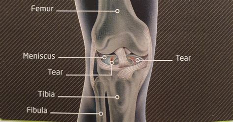 Knee Ligament Injury Klinique Pain Management And Wellbeing Clinic