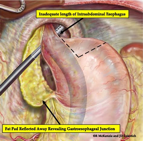 The Laparoscopic Approach To Paraesophageal Hernia Repair Semantic
