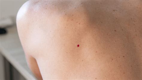 How To Get Rid Of Cherry Angiomas Aspire Dermatology