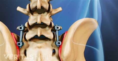 Spinal Fusion For Idiopathic Scoliosis