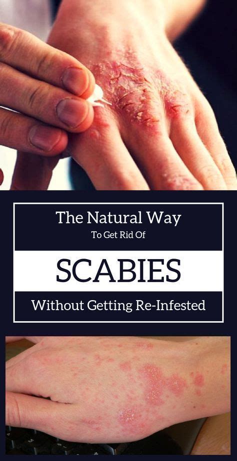 The Natural Way To Get Rid Of Scabies Without Getting Re Infested