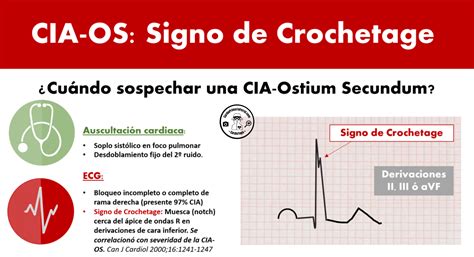 Cardiotruco Signo De Crochetage Cardioprimaria Ferrol