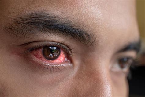 Do Red Eyes Mean Coronavirus Infection The Eye News