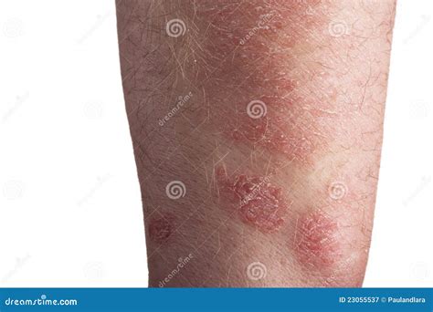 Psoriasis On The Arm Royalty Free Stock Photography Image 23055537
