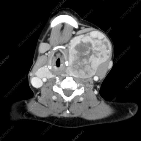 Large Thyroid Goiter Ct Stock Image C0365231 Science Photo Library