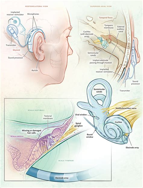 Cochlear Implantation In Adults Nejm