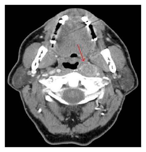 The Solitary Left Lateral Retropharyngeal Lymph Node Involvement