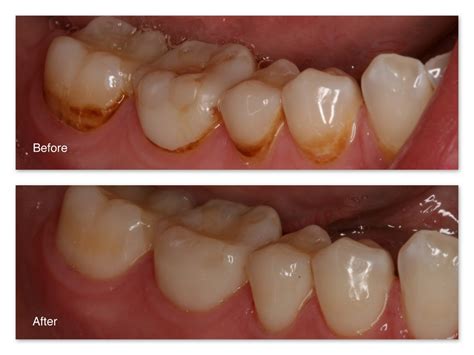 The brown stains seen in between the teeth in the gums are external stains that are due to substances deposited on the outer surface of teeth, behind the teeth. Tooth Stains Gallery - Dr. Jack M. Hosner, D.D.S.