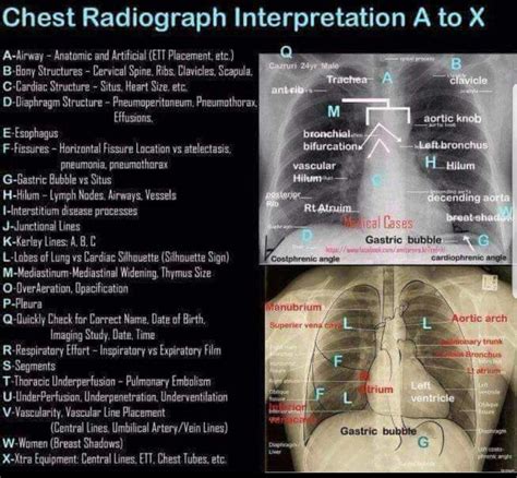 Chest X Ray Interpretation Rose Burgess