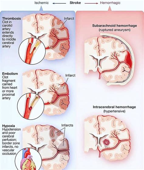 Different Types Of Brain Stroke Ischemic And Hemorrhage Brain