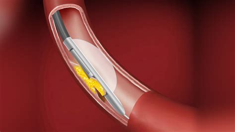 Atherectomy Surgery Types And Risks Of An Atherectomy