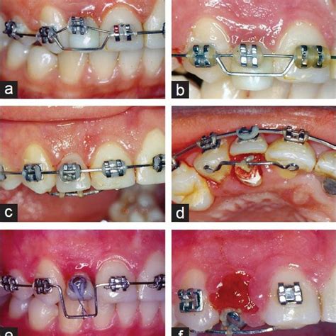 Calcium Deposits On Teeth Braces Teethwalls