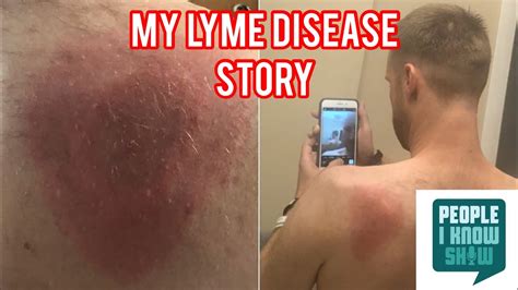 My Lyme Disease Story Curt Carstensen Dr Tom Moorcroft Youtube