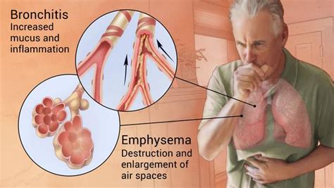 Chronic Obstructive Pulmonary Disease COPD AirPhysio