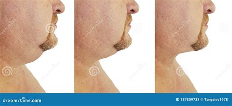 Submental Fat Man Before And After Removal Procedures Treatment Stock