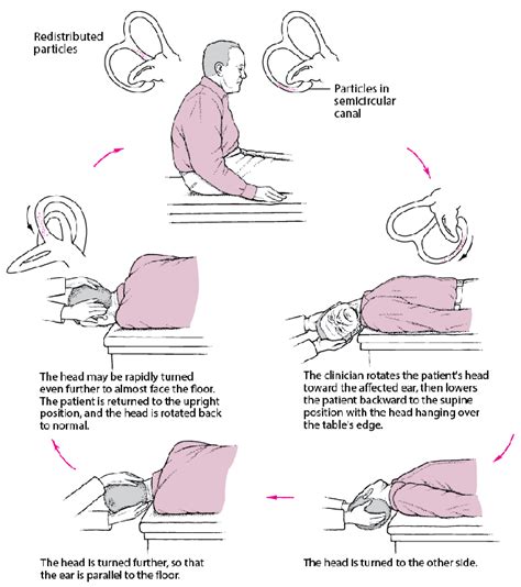 Figure Epley Maneuver A Simple Treatment For A Common Cause Of Vertigo Msd Manual