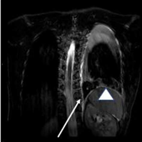 Pa Chest Radiograph Demonstrates A Left Lower Lobe Retrocardiac