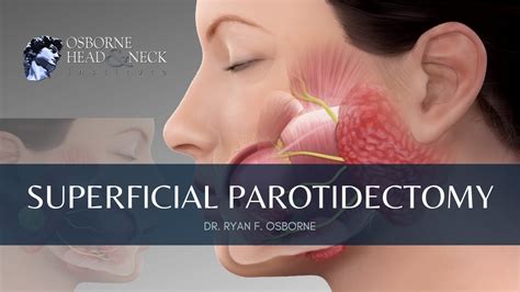 Superficial Parotidectomy Minimally Invasive Parotid Tumor Removal