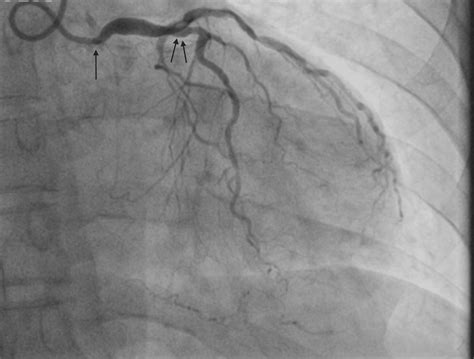 Cureus An Unusual Case Of Severe Aortic Stenosis And Triple Vessel