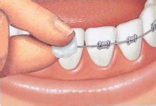 Check spelling or type a new query. Dental Braces Pain - How to Comfort Pain of Orthodontic Braces