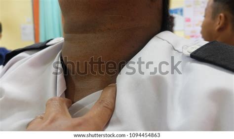 Diffuse Goitre Anterior Neck Swelling Stock Photo Edit Now 1094454863