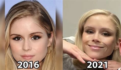 Erin Moriarty From The Boys New Face Plastic Surgery Analysis Video