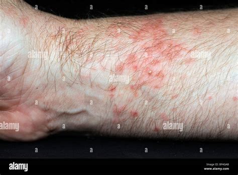 Very Red Blistered Skin Hives Or Urticaria After Contact With Sea