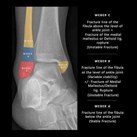 Weber Classification Of Ankle Fractures Pulse Md