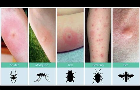 Pictures Of Baby Bed Bug Bites Get More Anythinks