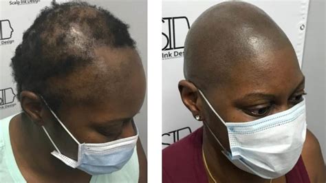 Scalp Micropigmentation Before And After Photos Smp For Women Hair