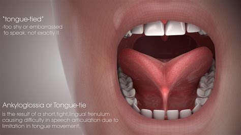 tongue tie shown and explained using a medical animation