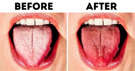 10 Natural Ways To Get Rid Of White Tongue