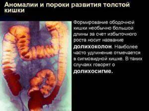 Диета при сигмоидите меню Диета при сигмоидите, воспаление сигмовидной кишки Диета при сигмоидите, воспаление сигмовидной кишки Диета при сигмоидите меню