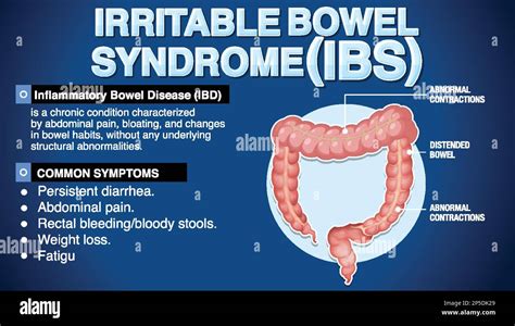 Irritable Bowel Syndrome Ibs Infographic Illustration Stock Vector