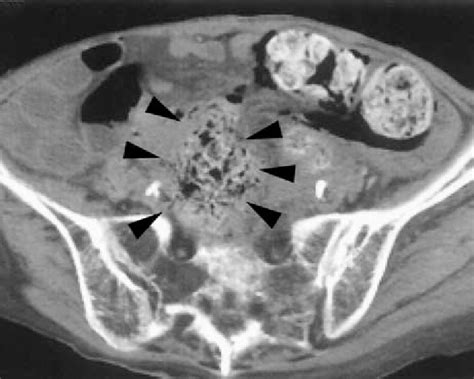 Contrast Enhanced Ct Image Of Spontaneous Perforation Of The Sigmoid